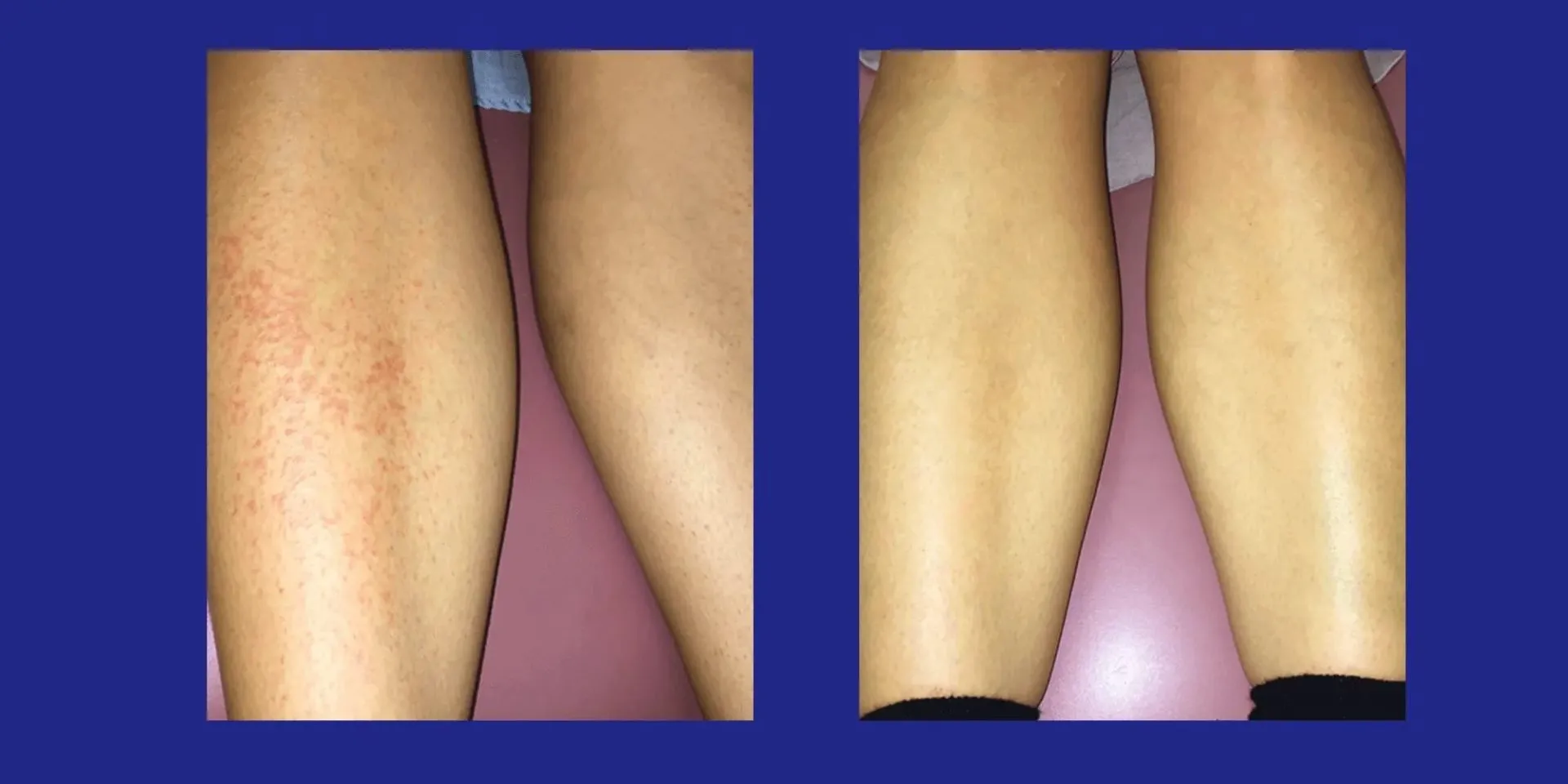 Measles on the Legs